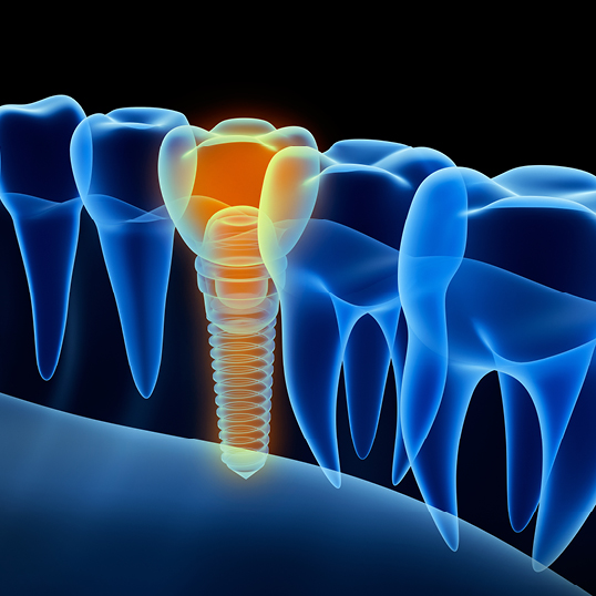 Implantat in Zahnreihe