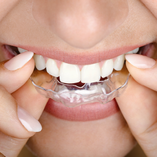 Alignerschienen - transparente Zahnkorrektur